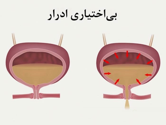 بهترین متخصص زنان و زایمان اصفهان | لیزر جهت رفع بی اختیاری های ادراری