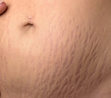 بهترین متخصص زنان و زایمان اصفهان | درمان استرچ مارک با پلاسما جت