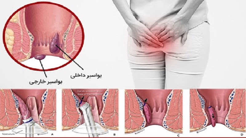 تشخیص و درمان هموروئید و بواسیر | بهترین متخصص زنان و زایمان اصفهان