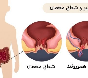 تشخیص و درمان هموروئید و بواسیر | بهترین متخصص زنان و زایمان اصفهان