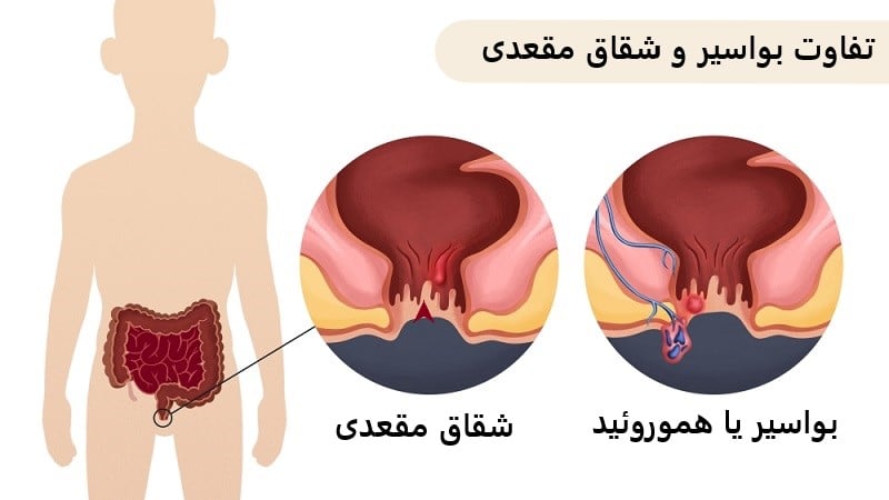 تشخیص و درمان هموروئید و بواسیر | بهترین متخصص زنان و زایمان اصفهان