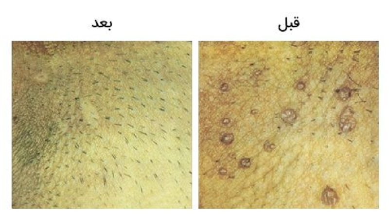 درمان و جراحی زگیلهای تناسلی با لیزر | بهترین متخصص زنان و زایمان اصفهان
