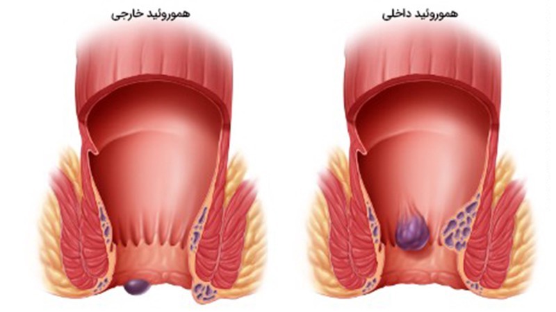 هموروئید چیست ؟ | بهترین متخصص زنان و زایمان اصفهان