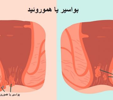 هموروئید چیست ؟ | بهترین متخصص زنان و زایمان اصفهان
