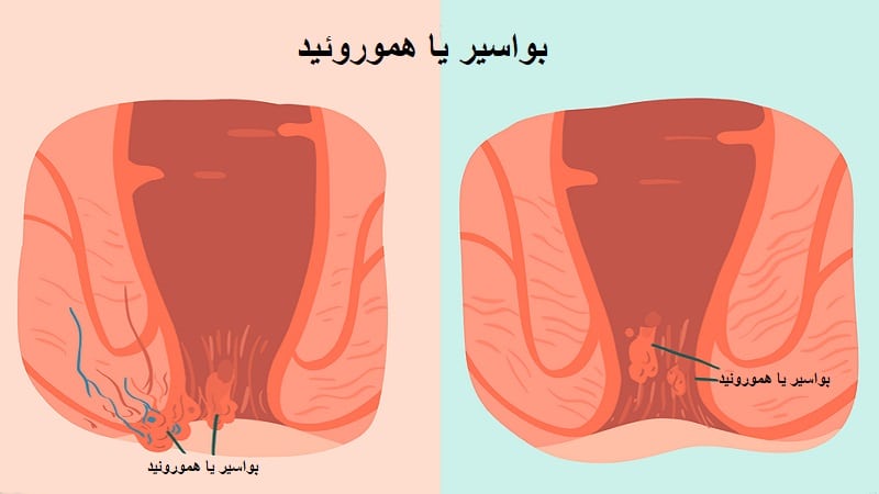 هموروئید چیست ؟ | بهترین متخصص زنان و زایمان اصفهان