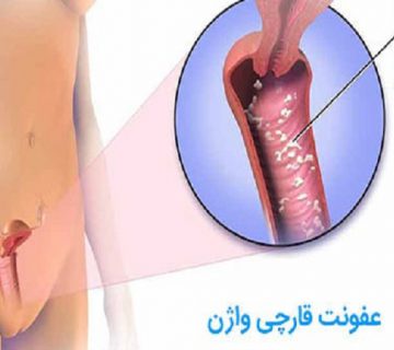 درمان های خانگی عفونت قارچی واژن | بهترین متخصص زنان و زایمان اصفهان