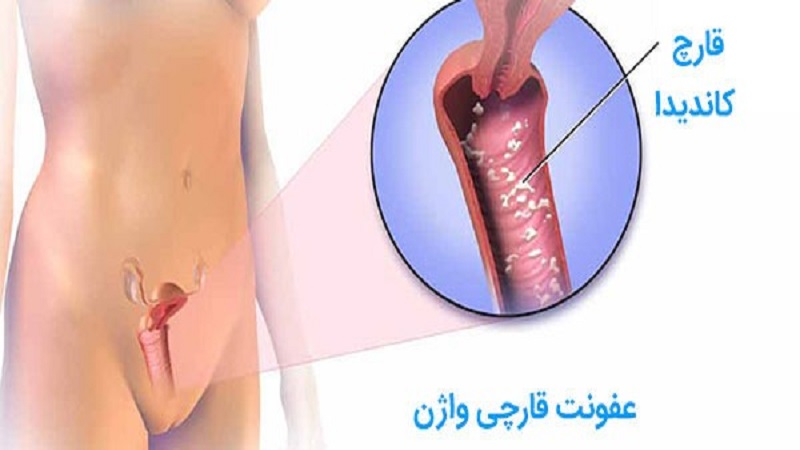 درمان های خانگی عفونت قارچی واژن | بهترین متخصص زنان و زایمان اصفهان