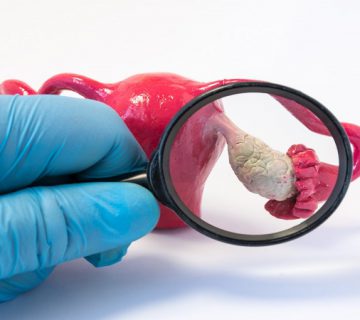 بهترین متخصص زنان و زایمان اصفهان _ تخمدان پلی کیستیک