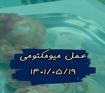 متخصص زنان و زایمان اصفهان | عمل جراحی میومکتومی