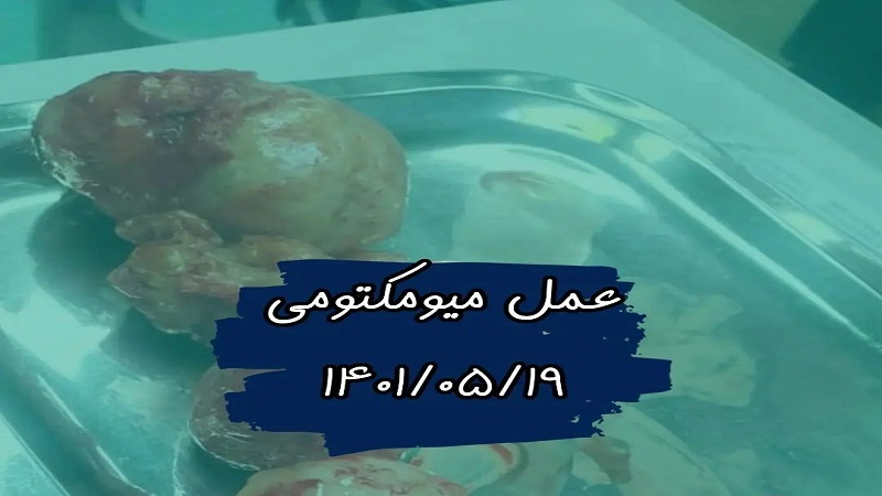 متخصص زنان و زایمان اصفهان | عمل جراحی میومکتومی