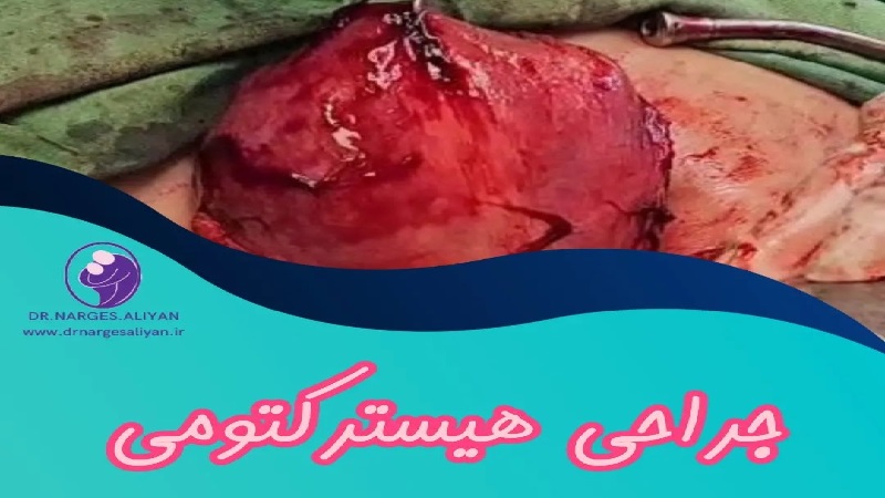 متخصص زنان و زایمان اصفهان | جراحی هیسترکتومی
